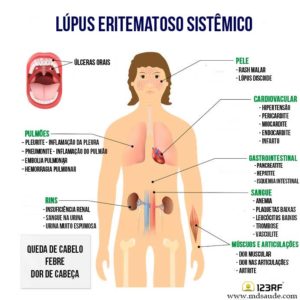 lupus