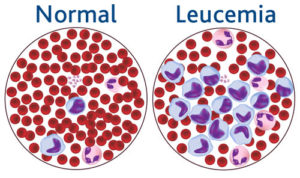 leucemia