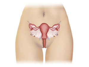 o-que-e-endometriose